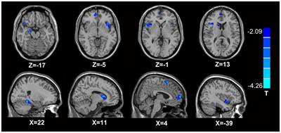 Microstructural Abnormalities Were Found in Brain Gray Matter from Patients with Chronic Myofascial Pain